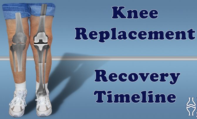 Knee Surgery Recovery Timeline : Need You to Know ?