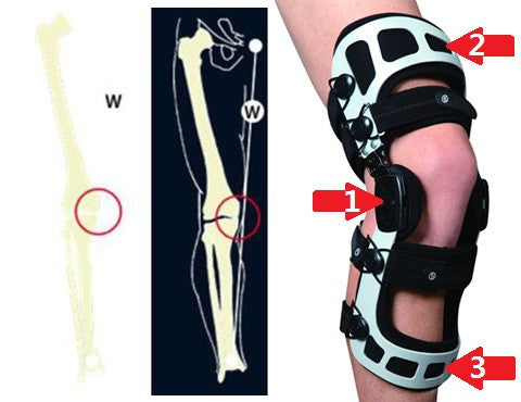 What causes OA? How does a knee brace help? - Valgus / Varus